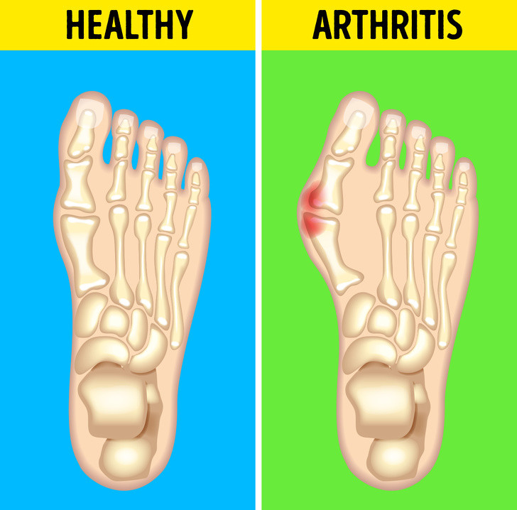 Đau khớp chân: Đau khớp chân, còn được gọi là viêm khớp dạng thấp, là một tình trạng mà hệ thống miễn dịch tấn công nhầm mô trong cơ thể. Nó có thể dẫn đến xói mòn xương và biến dạng khớp.