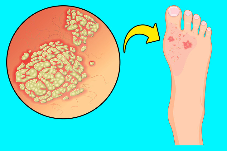 Nấm chân là bệnh viêm da ảnh hưởng đến phần chân và da ở giữa các ngón chân. Bệnh có thể được chữa khỏi rất dễ dàng bằng các loại kem chống nấm, tuy nhiên, nếu bạn bị bệnh tiểu đường hoặc hệ miễn dịch yếu thì nên đi khám bác sĩ. Ảnh: BS.