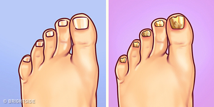 Móng chân màu vàng, dày hơn so với bình thường là biểu hiện của nhiễm nấm. Vệ sinh kém là một trong những nguyên nhân hàng đầu gây nhiễm nấm ở móng chân. Nếu có dấu hiệu này, bạn nên đi khám để điều trị sớm.