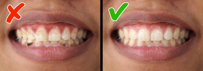 Viêm nha chu: Ngoài vấn đề vệ sinh răng miệng kém hoặc hút quá nhiều thuốc, thiếu hụt vitamin D cũng dẫn đến viêm nha chu. Nên ăn nhiều các sản phẩm từ sữa, gạo nâu, cà chua, đậu, cá, cam, quýt, và nho.