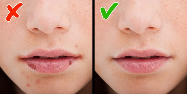 Lở loét ở góc mép là dấu hiệu báo cơ thể thiếu vitamin B2, B3, B12, các vitamin giàu sắt và kẽm. Nên ăn nhiều thịt gia cầm, cá (cá hồi, cá ngừ), trứng, đậu và các loại hạt. Bạn nên kết hợp các loại thực phẩm này với rau vì vitamin C trong rau giúp chống lại nhiễm trùng và cải thiện sự trao đổi chất của sắt. Ảnh: BS.