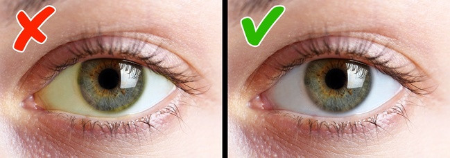 Vàng mắt: Lòng trắng mắt có màu vàng là do thiếu hụt vitamin B12. Để bổ sung vitamin này, bạn nên ăn gan, sữa bò, cá hồi, cá ngừ và thịt cừu.