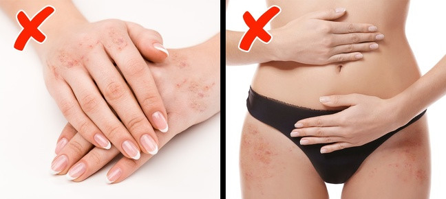 Nổi mẩn ở tay và hông: Các vết đỏ như mụn trứng cá xuất hiện ở tay và hông do thiếu vitamin A, D và các axit béo. Bạn nên tăng cường ăn nhiều cà rốt, ớt đỏ, cá hồi và cắt giảm các thực phẩm chứa chất béo chuyển hóa.