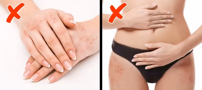 Nổi mẩn ở tay và hông: Các vết đỏ như mụn trứng cá xuất hiện ở tay và hông do thiếu vitamin A, D và các axit béo. Bạn nên tăng cường ăn nhiều cà rốt, ớt đỏ, cá hồi và cắt giảm các thực phẩm chứa chất béo chuyển hóa.