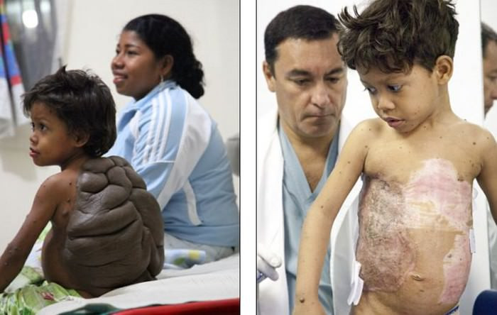 Didier Montalvo, sinh năm 2006 tại Colombo, Sri Lanka, có một nốt ruồi rất lớn trên lưng, trông giống như một vỏ rùa. May mắn, cậu bé này đã được đưa đến Anh phẫu thuật cắt bỏ “mai rùa”.