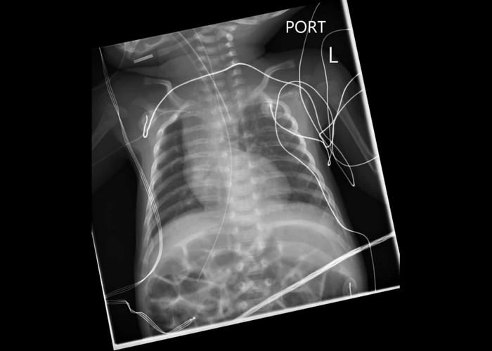 Bethany Jordan ở Stourbridge, Anh, mắc hội chứng Ivemark khiến cô phát triển dạ dày sai chỗ, gan bị lệch và trái tim cô cũng không nằm đúng chỗ. Cô có hai lá phổi trái và năm lá lách trong khi mọi người chỉ có một.