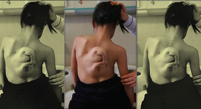 Yin Xin ở Trung Quốc, cũng có một cánh tay nhỏ mọc lên từ lưng từ khi sinh ra. May mắn, cô bé đã được phẫu thuật cắt bỏ bộ phận thừa trong năm 2007.
