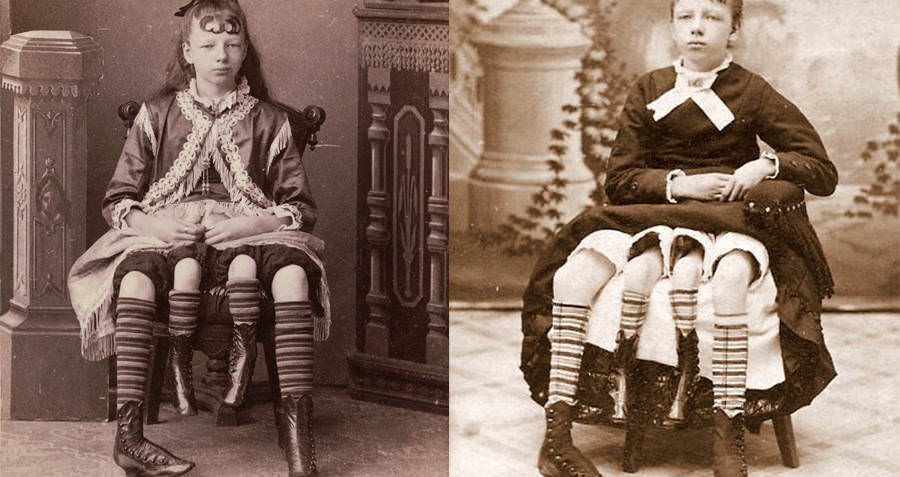 Myrtle Corbin mắc dipygus, một dị dạng bẩm sinh khiến bà ấy có hai xương chậu riêng biệt, nằm cạnh nhau và một cặp chân phụ. Người phụ nữ này đã mất năm 1928 ở tuổi 60.