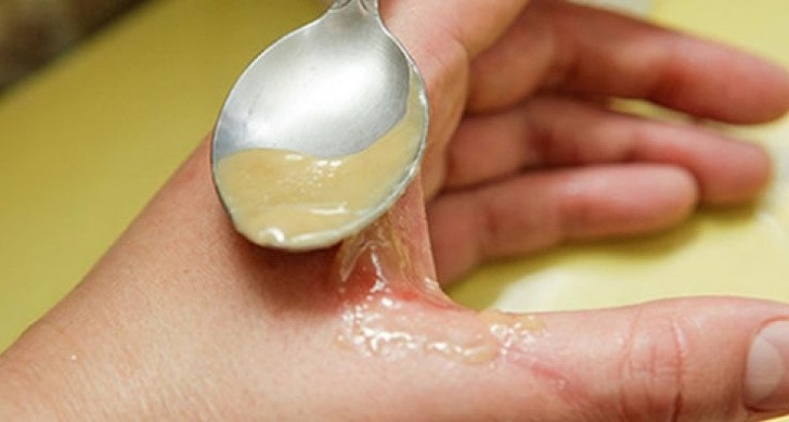 Làm kháng sinh: Bôi mật ong lên vết thương để tăng tốc độ chữa lành và ngăn ngừa vi khuẩn lây lan.