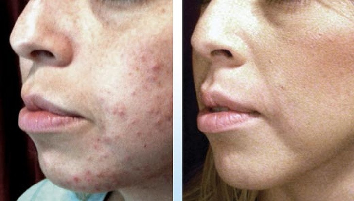 Làm mờ sẹo: Hãy bôi hỗn hợp gồm mật ong và dầu dừa hoặc dầu ô liu vào vùng da sẹo và để yên trong 15 phút. Cách này sẽ giúp làm mờ vết sẹo.