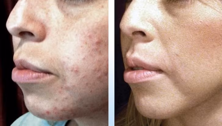 Làm mờ sẹo: Hãy bôi hỗn hợp gồm mật ong và dầu dừa hoặc dầu ô liu vào vùng da sẹo và để yên trong 15 phút. Cách này sẽ giúp làm mờ vết sẹo.