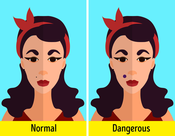 Thay đổi nốt ruồi: Nếu bạn nhận thấy nốt ruồi mới và bất thường hoặc nốt ruồi cũ đã thay đổi hình dạng hoặc màu sắc của nó, bạn cũng nên đi kiểm tra tình trạng sức khỏe.