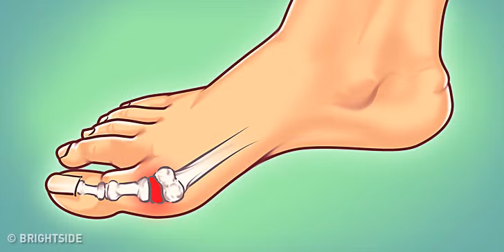 Gout có thể hiểu một cách rất đơn giản là chứng sưng khớp - thường xảy ra ở ngón chân cái, do lượng acid uric trong máu tăng cao. Nghe có vẻ đơn giản nhưng việc khớp sưng đỏ lên đi kèm với những cơn đau thực sự khủng khiếp.