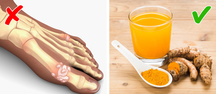 Tương tự, nghệ cũng là một siêu thực phẩm dành cho người bị gout. Theo các chuyên gia y tế, chỉ cần uống một cốc nước pha bột nghệ, bạn sẽ thấy cơn đau giảm đi đáng kể. Ảnh: BS.