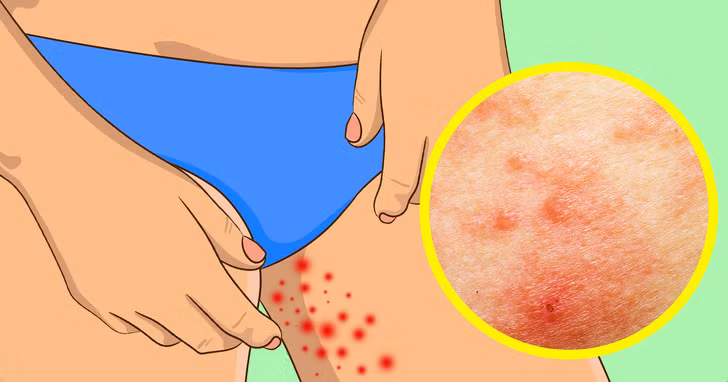 Nếu bị kích ứng da sau một ngày mặc quần short hoặc váy ngắn đi bộ trong ngày nóng, bạn hãy thường xuyên dưỡng ẩm cho làn da. Sử dụng các loại kem có chứa các vitamin C và E tự nhiên hoặc chiết xuất từ dưa chuột.