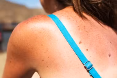 Cháy nắng: Việc cháy nắng thực sự có thể làm tăng lượng đường trong máu. Do vậy, hãy nhớ bôi kem chống nắng mỗi khi ra ngoài trong ngày hè.