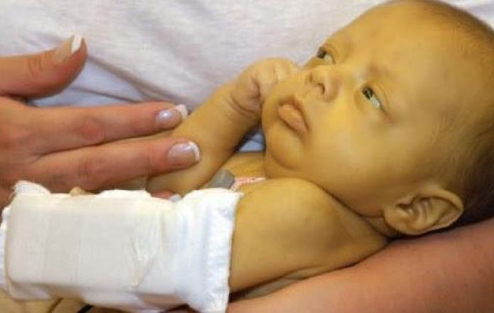 Sốt vàng da là một dạng bệnh sốt xuất huyết không có biện pháp điều trị. Sau một thời gian bệnh nặng, 15% bệnh nhân bị biến chứng với cơn sốt cao hơn, vàng da và chảy máu trong. Khoảng một nửa số bệnh nhân biến chứng tử vong.