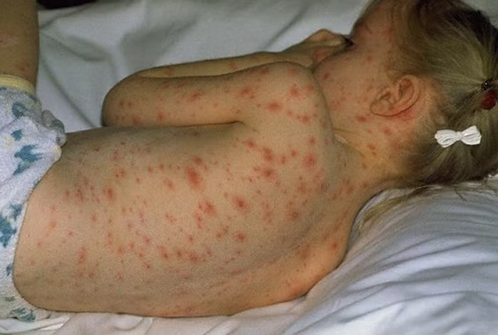 Sốt xuất huyết là một trong những bệnh nguy hiểm do muỗi gây ra, chủ yếu xuất hiện ở những vùng khí hậu nhiệt đới và cận nhiệt đới như Puerto Rico, quần đảo Thái Bình Dương, châu Mỹ Latinh và Đông Nam Á.