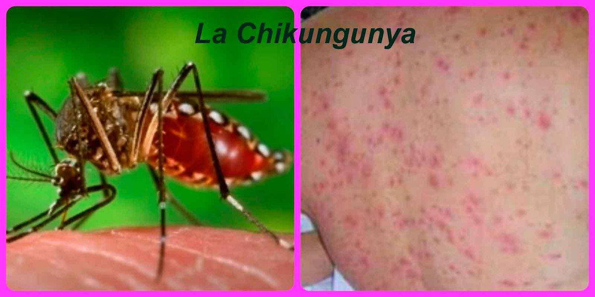 Sốt Chikungunya là bệnh do virus Chikungunya lây nhiễm qua trung gian muỗi. Các triệu chứng phổ biến của bệnh là nhức đầu, nôn mửa, đau lưng, phát ban da và đau khớp kéo dài một vài tuần.