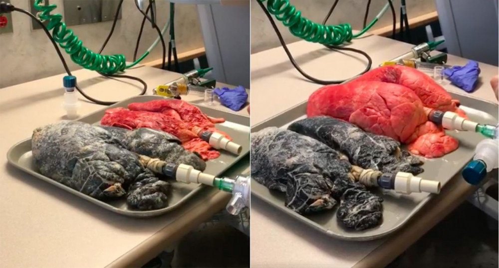 Lá phổi đen đúa, hỏng vì thuốc lá đặt cạnh lá phổi bình thường.