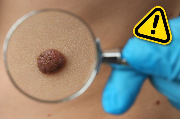 Tự tẩy nốt ruồi ở nhà rất nguy hiểm. Nếu bạn đang muốn loại bỏ nó, hãy tìm sự hỗ trợ của bác sĩ da liễu.