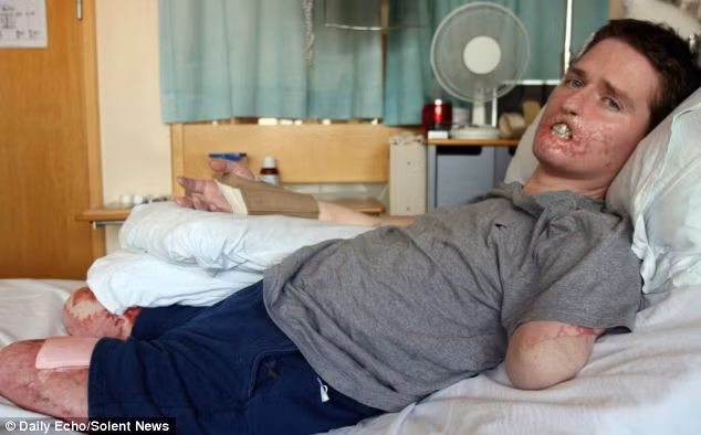 Alex Lewis sau khi cắt bỏ tứ chi và một phần gương mặt nhiễm độc để sống sót. Alex Lewis sau khi cắt bỏ tứ chi và một phần gương mặt nhiễm độc để sống sót.