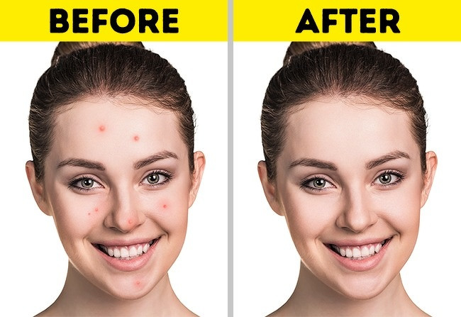 Thói quen không giặt vỏ gối thường xuyên có thể tích tụ vi khuẩn và gây ra mụn trứng cá trên mặt.