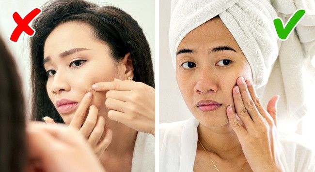 Nặn mụn bằng tay chỉ sẽ chỉ lây lan nhiễm trùng trên khuôn mặt của bạn.