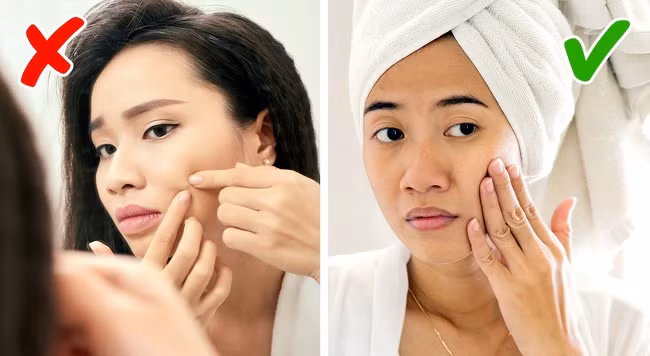 Nặn mụn bằng tay chỉ sẽ chỉ lây lan nhiễm trùng trên khuôn mặt của bạn.