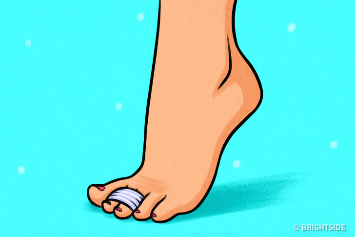 Băng các ngón chân của bạn: Bạn có thể dán từng ngón chân lại để giảm áp lực cho dây thần kinh giữa hai ngón chân gây đau.