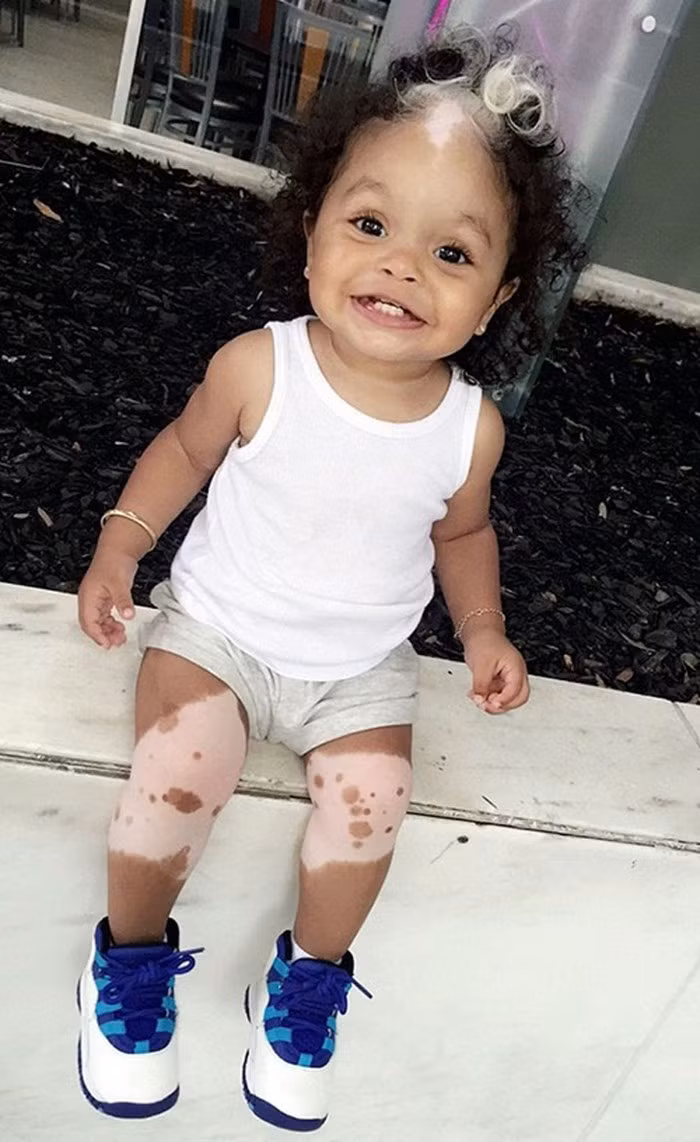 Worthy có vùng tóc màu trắng là do mắc một hội chứng có tên là poliosis, một điều kiện nhiễm sắc thể gây ra bởi sự thiếu sắc tố về tóc và da.