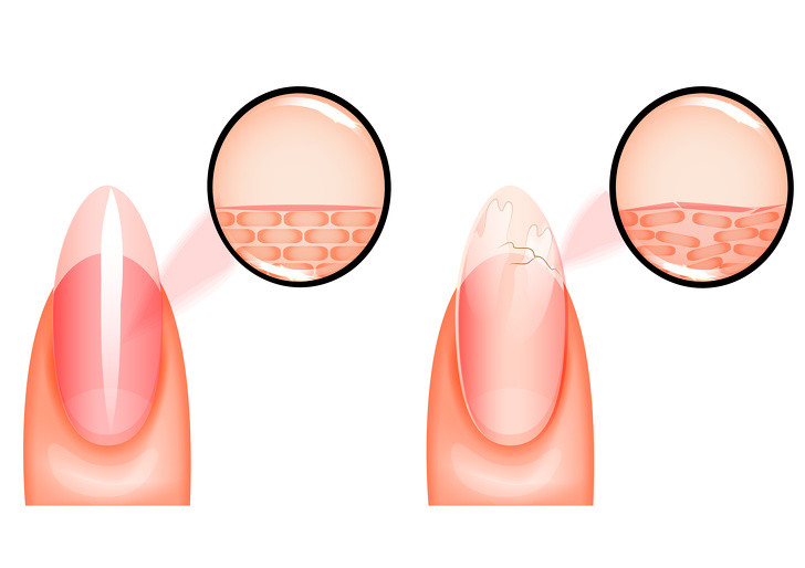 Móng tay dễ gãy là một triệu chứng ít phổ biến của tình trạng thiếu sắt xuất hiện ở giai đoạn muộn của thiếu máu.