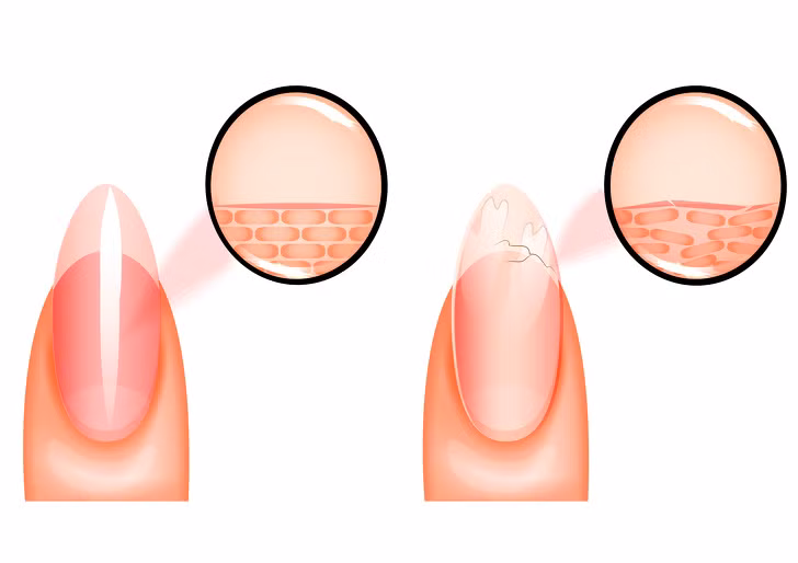 Móng tay dễ gãy là một triệu chứng ít phổ biến của tình trạng thiếu sắt xuất hiện ở giai đoạn muộn của thiếu máu.