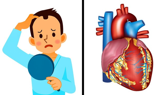 Chứng hói đầu có thể là dấu hiệu của bệnh tim: Các nhà khoa học nhận thấy những người bị các chứng bệnh tim mạch trở nên hói đầu hoặc tóc của họ chuyển sang màu xám.
