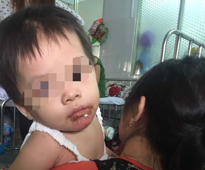 Be gai 18 thang bong nang o mieng, me to do bao mau