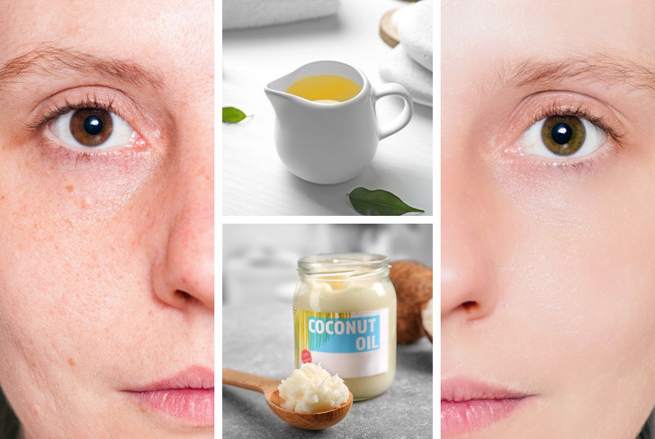 Tinh dầu trà/tràm có đặc tính sát trùng mạnh mẽ, giúp điều trị mụn trứng cá và các tình trạng viêm da khác. Dầu cây trà có thể bôi trực tiếp lên da nhưng bạn nên pha loãng với dầu dừa thì tốt hơn.