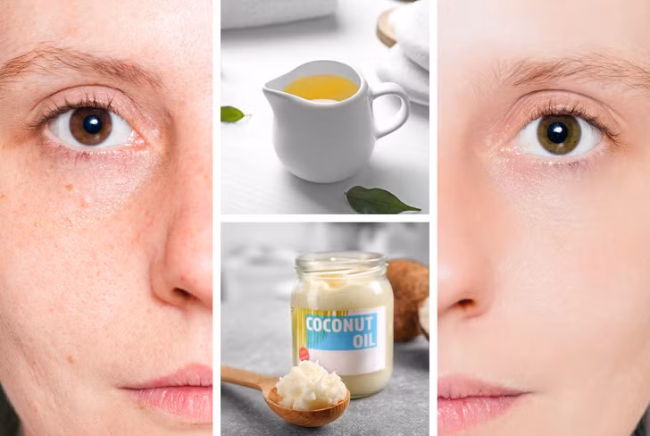 Tinh dầu trà/tràm có đặc tính sát trùng mạnh mẽ, giúp điều trị mụn trứng cá và các tình trạng viêm da khác. Dầu cây trà có thể bôi trực tiếp lên da nhưng bạn nên pha loãng với dầu dừa thì tốt hơn.