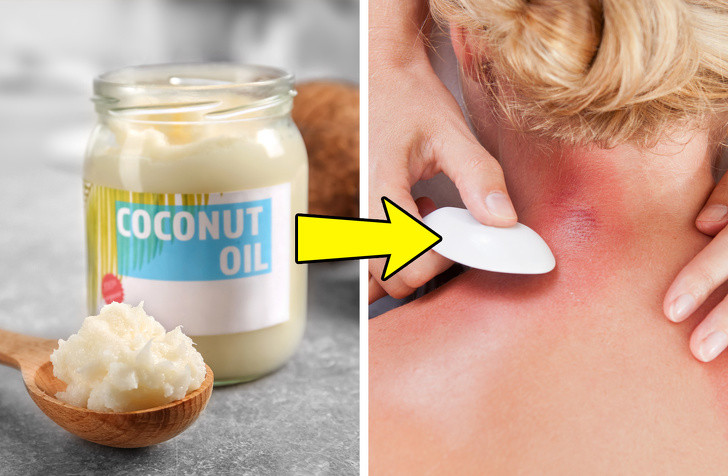 Dầu dừa điều trị bệnh vẩy nến và eczema bằng cách giữ ẩm cho làn da. Uống một muỗng canh dầu dừa mỗi ngày kết hợp với bôi vào vùng da ảnh hưởng.