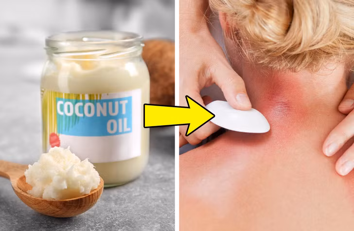 Dầu dừa điều trị bệnh vẩy nến và eczema bằng cách giữ ẩm cho làn da. Uống một muỗng canh dầu dừa mỗi ngày kết hợp với bôi vào vùng da ảnh hưởng.