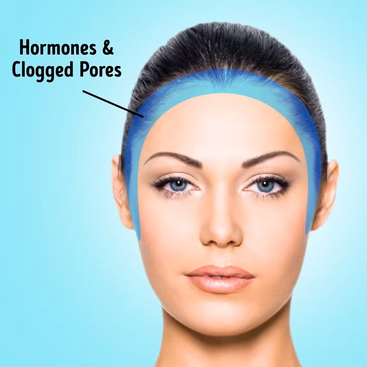 Mụn trứng cá xuất hiện theo đường chân tóc và gần tai có thể lỗ chân lông tắc hoặc bị kích thích do mỹ phẩm. Bạn nên chọn những sản phẩm làm đẹp tự nhiên, hữu cơ để cải thiện tình trạng này.