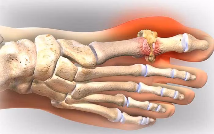Bệnh gút hay còn gọi là bệnh gout, là một loại viêm khớp đột ngột gây sưng đỏ và đau ở các khớp. Bệnh xảy ra khi tinh thể acid uric lắng đọng trong các khớp của cơ thể, đặc biệt là ngón chân cái, mắt cá chân, đầu gối, khuỷu tay, cổ tay và ngón tay.