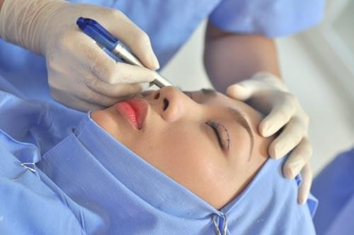 Với mỗi ca phẫu thuật cắt mí mắt tốn khoảng 1 giờ đồng hồ để thực hiện.