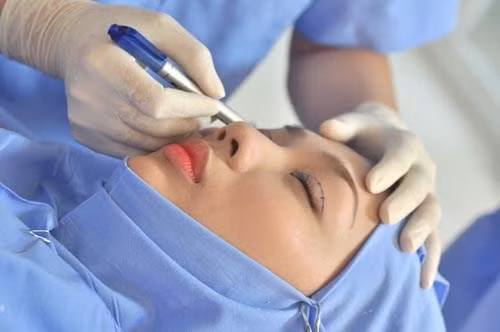 Với mỗi ca phẫu thuật cắt mí mắt tốn khoảng 1 giờ đồng hồ để thực hiện.