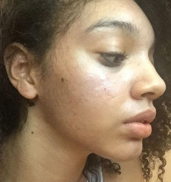 Nhờ chăm chỉ đắp mặt nạ và dưỡng da, Brianna đã tiêu diệt toàn bộ mụn trên da. Cô đã chia sẻ bí quyết làm đẹp của mình lên mạng xã hội và nhận được hơn 10.000 lượt thích.