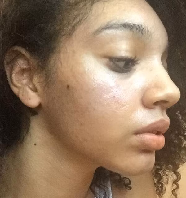 Nhờ chăm chỉ đắp mặt nạ và dưỡng da, Brianna đã tiêu diệt toàn bộ mụn trên da. Cô đã chia sẻ bí quyết làm đẹp của mình lên mạng xã hội và nhận được hơn 10.000 lượt thích.