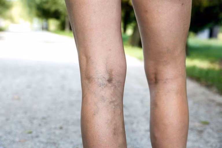 Nổi gân xanh, gân đỏ (Giãn tĩnh mạch) là tình trạng phổ biến ở phụ nữ có thai do các mao mạch máu mỏng manh và dễ vỡ hơn. Những đường gân này sẽ từ từ biến mất đi khi các hormone trong cơ thể cân bằng sau khi sinh một thời gian.