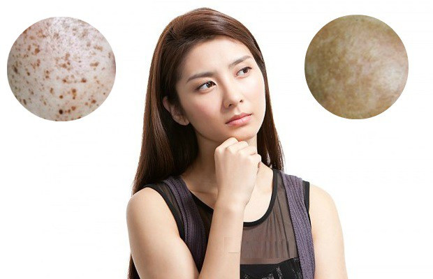 Nám, sạm da: Trong quá trình mang thai, các hắc tố melamin trong da tăng lên đáng kể khiến cho mẹ bầu xuất hiện các mảng da tối màu trên trán, má, cổ, nách, ngực. Các nốt ruồi và tàn nhang cũng trở nên đậm màu hơn.