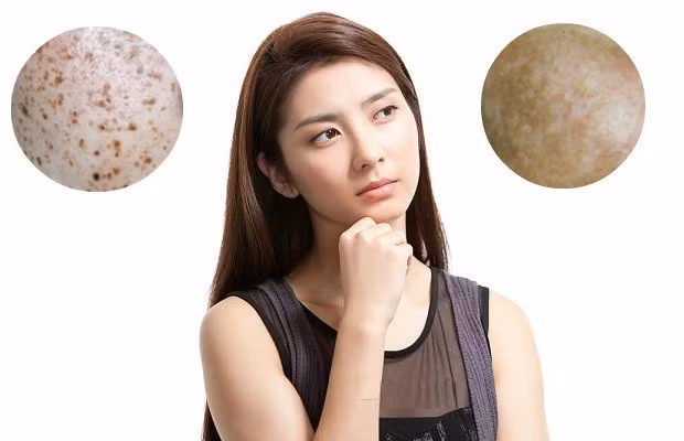 Nám, sạm da: Trong quá trình mang thai, các hắc tố melamin trong da tăng lên đáng kể khiến cho mẹ bầu xuất hiện các mảng da tối màu trên trán, má, cổ, nách, ngực. Các nốt ruồi và tàn nhang cũng trở nên đậm màu hơn.