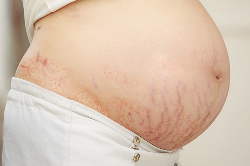 Rạn da là thay đổi khá phổ biến của các mẹ bầu. Gần 90% phụ nữ mang thai phải trải qua cảnh tượng những vết rạn nâu đỏ xuất hiện vằn vèo trên vùng bụng, hông, đùi, ngực như những chiếc mạng nhện dày đặc, đặc biệt là trong những tháng cuối của thai kì.