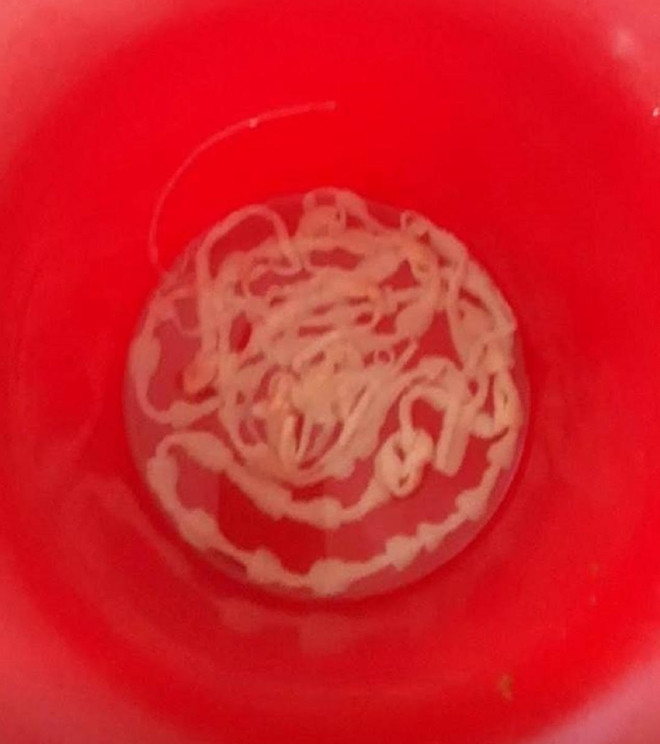 Con sán xơ mít kí sinh trong cơ thể người đàn ông suốt 43 năm qua.